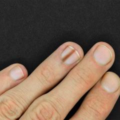 An image of a hand showing a nail matrix melanoma